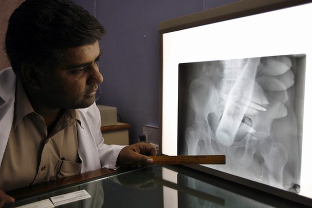 Dr. Raj Persaude examines yet another xray of what appears to be a coke bottle lodged in